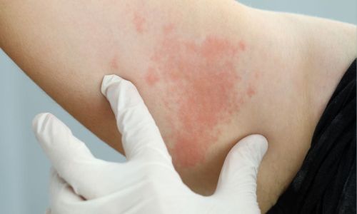 Prima Visita Dermatologica Bergamo
