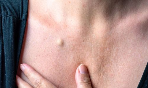 Rimozione di Cisti Sebacee Bergamo