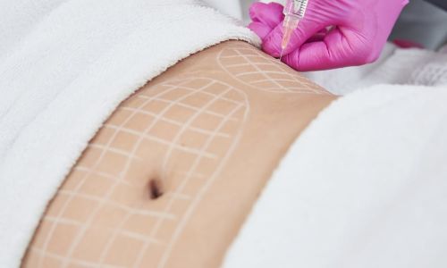 Lipofilling Bergamo