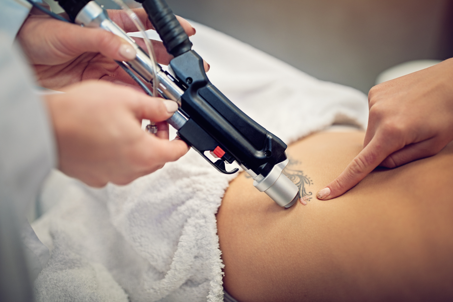 Laser Tatuaggi: trattamento laser per la rimozione dei tattoo