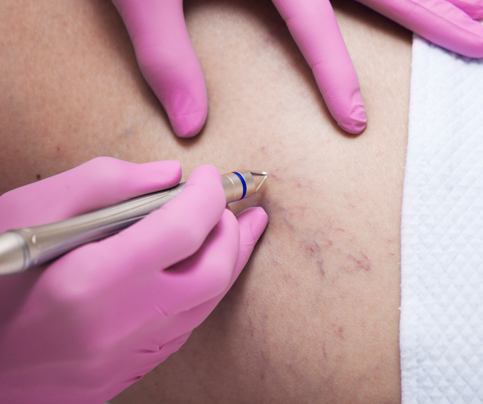 Laserterapia per capillari: una soluzione indolore per migliorare la salute della pelle