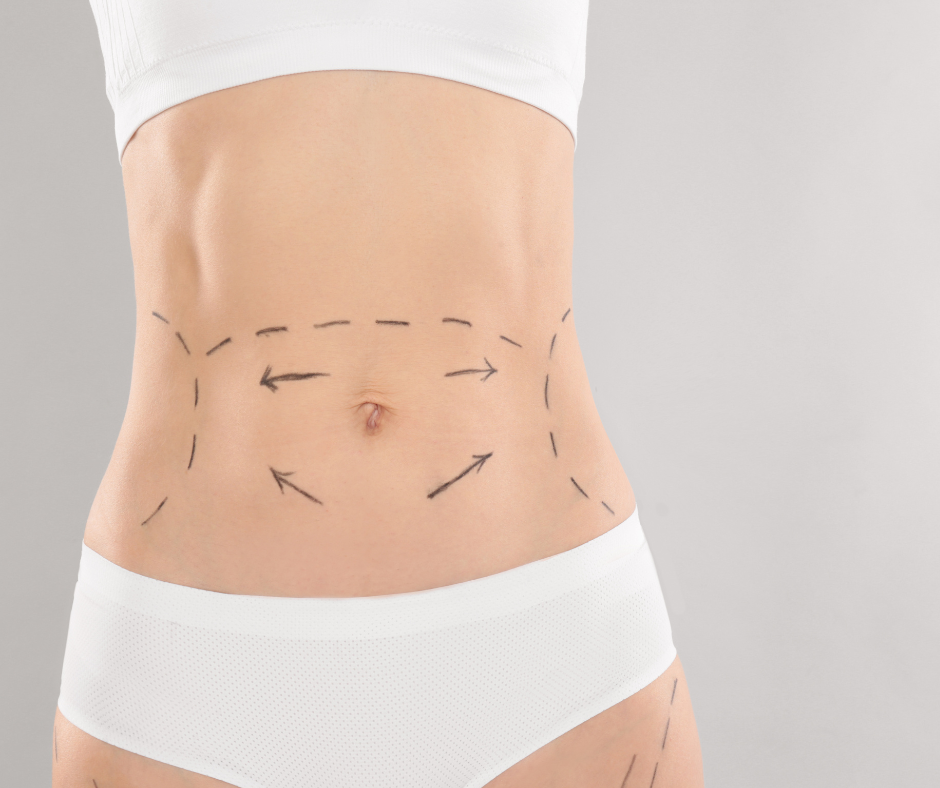 Liposuzione addome: procedure e benefici