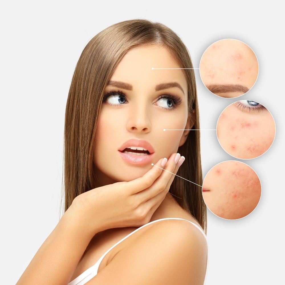 Rimozione Acne Laser co2 frazionato