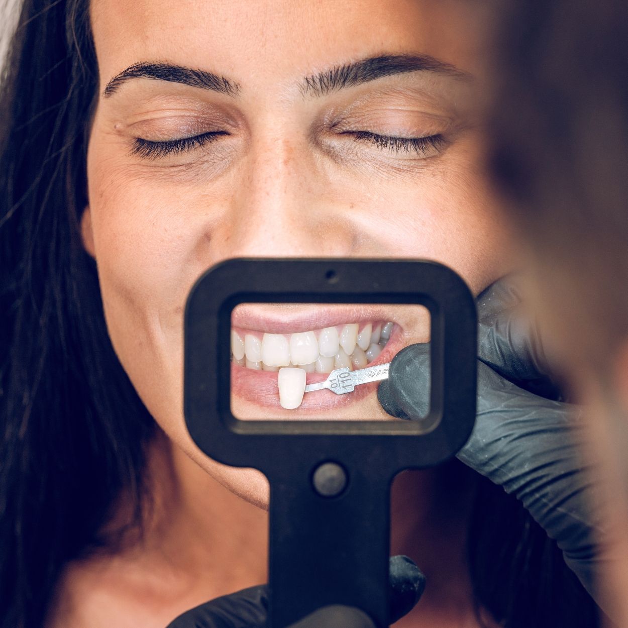 faccette dentali