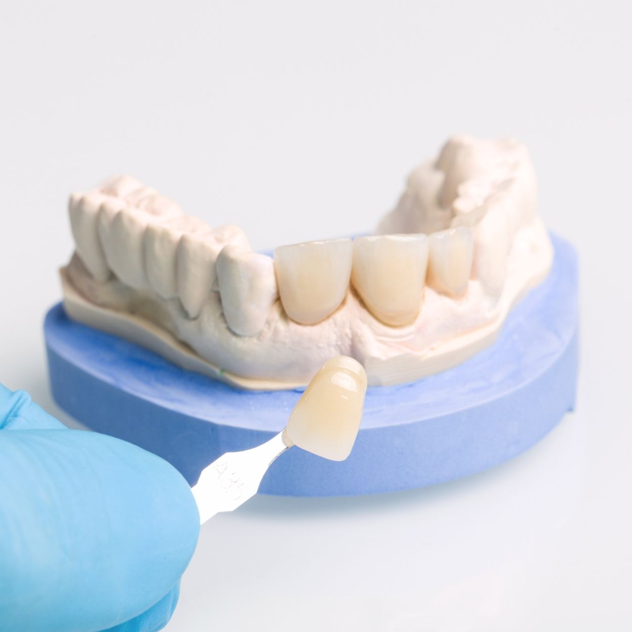 faccette dentali