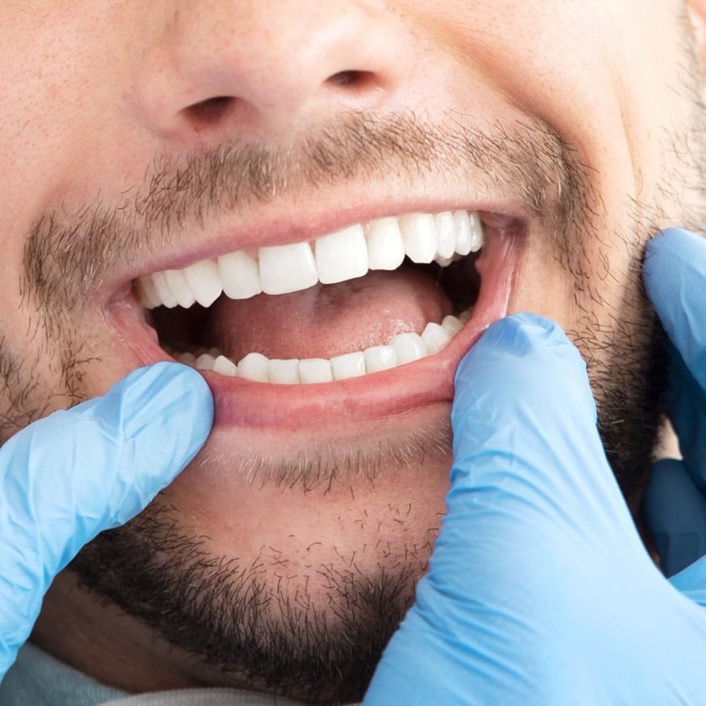 impianti denti fissi
