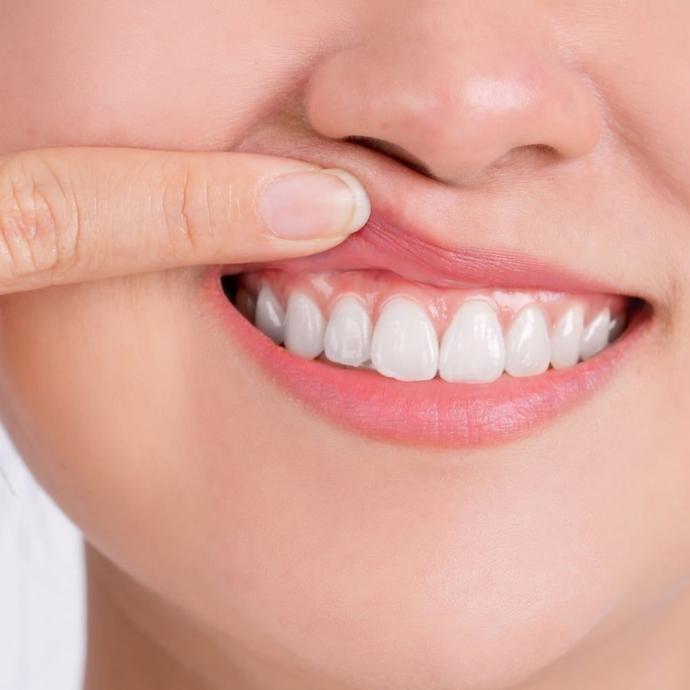 Denti fissi in 48h