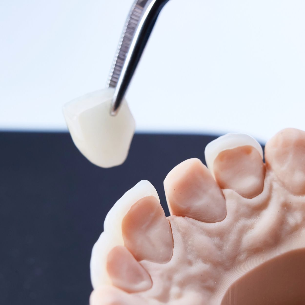 faccette dentali
