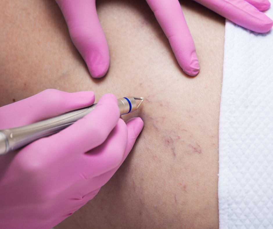 Laser terapia per capillari laserterapia capillari - finazzi