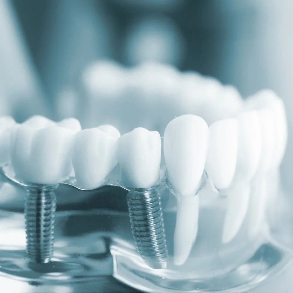 implantologia dentale a bergamo implantologia dentale