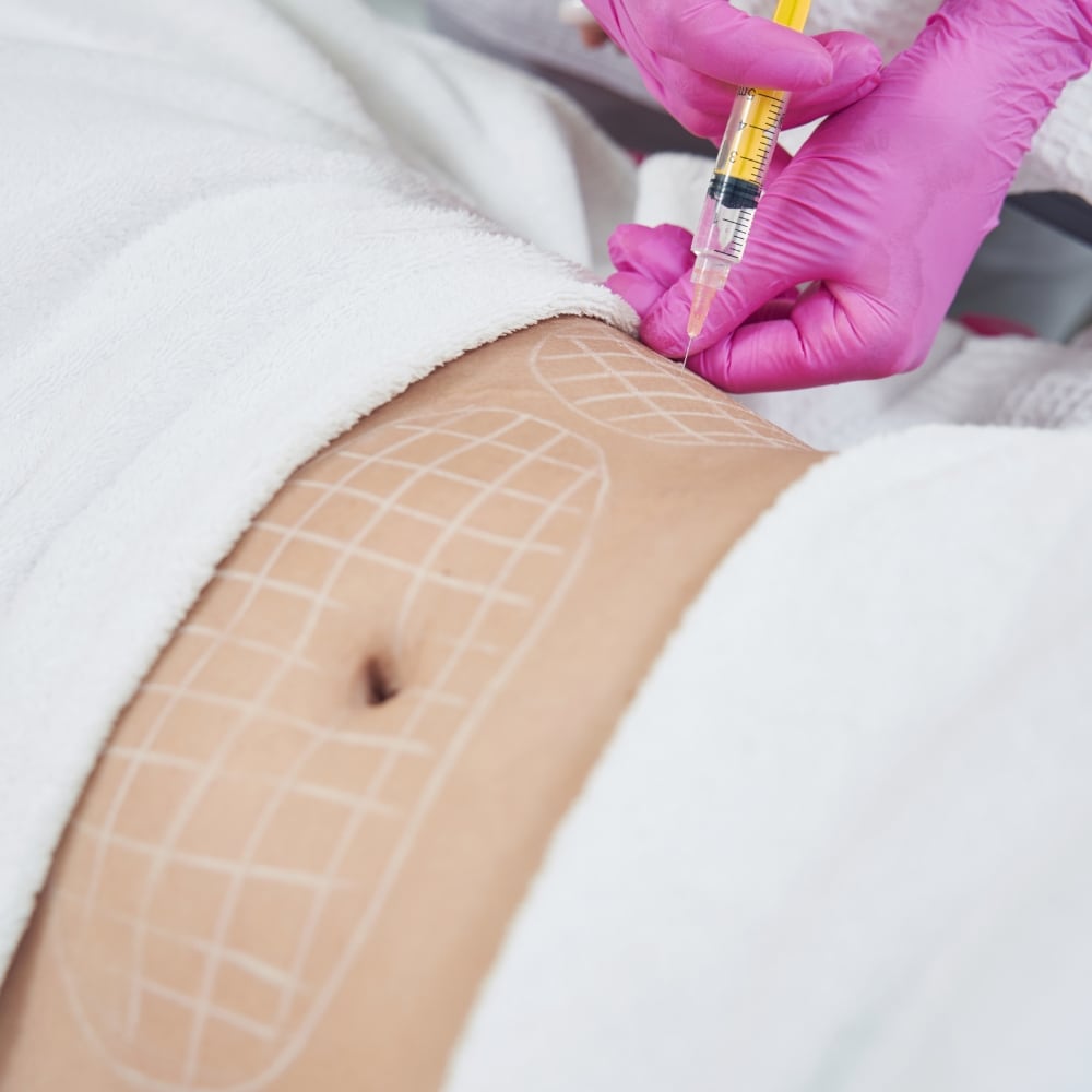 Lipofilling
