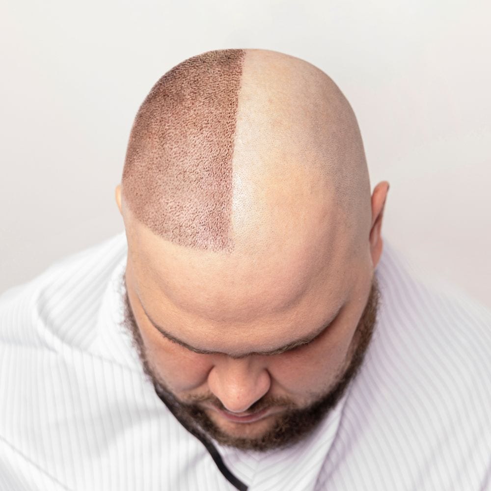 Laser co2 frazionato