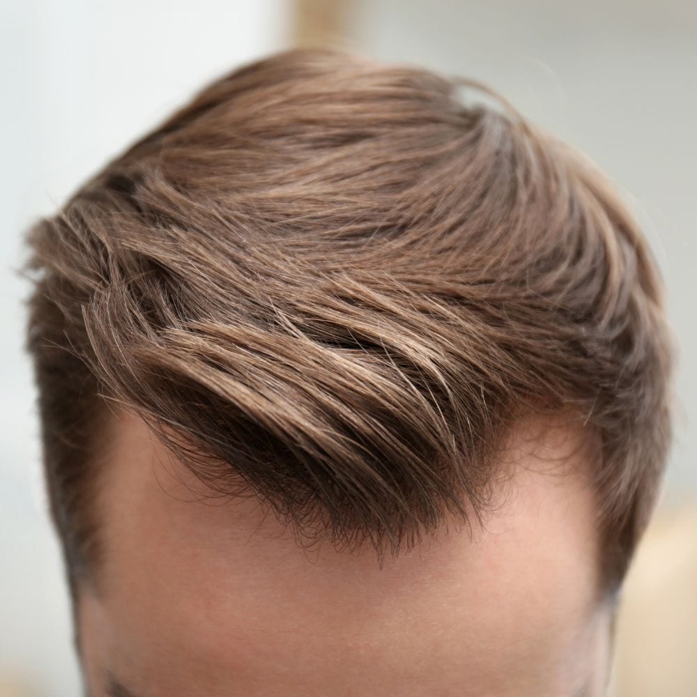 trapianto di capelli