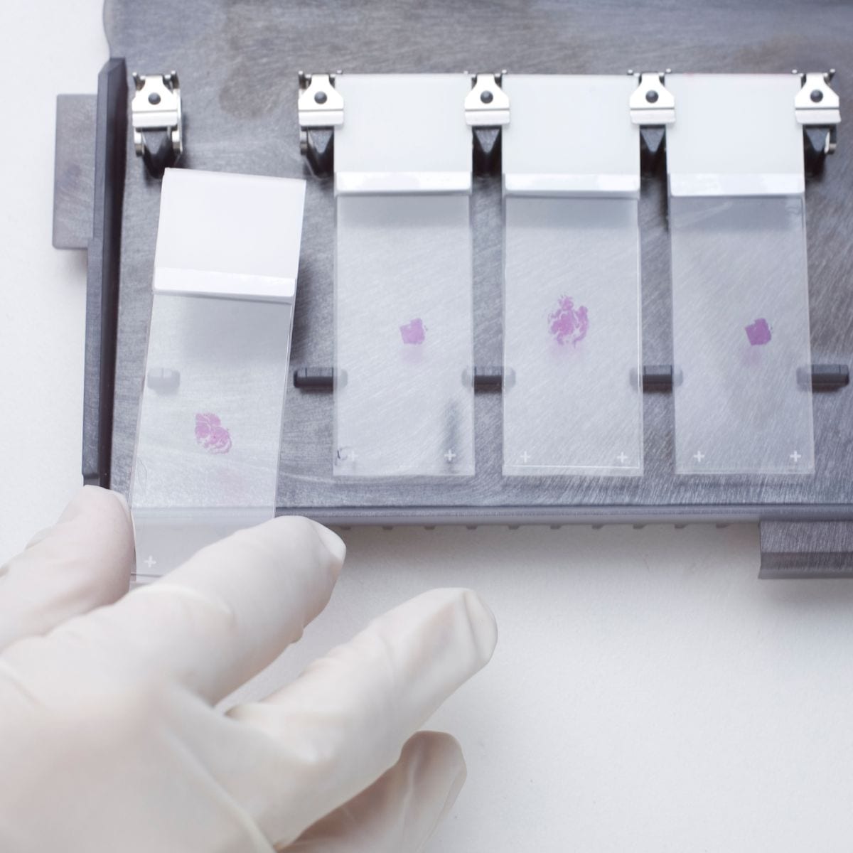 Rimozione di Cisti Sebacee