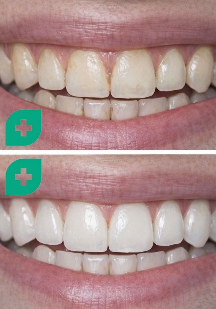 igiene dentale a bergamo