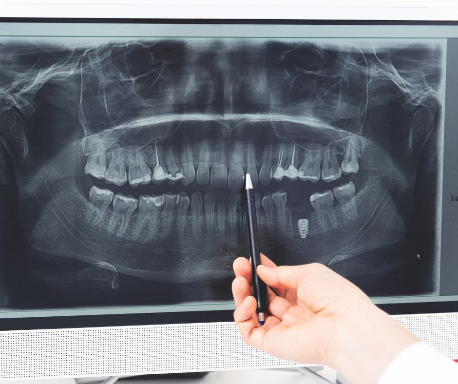 implantologia dentale