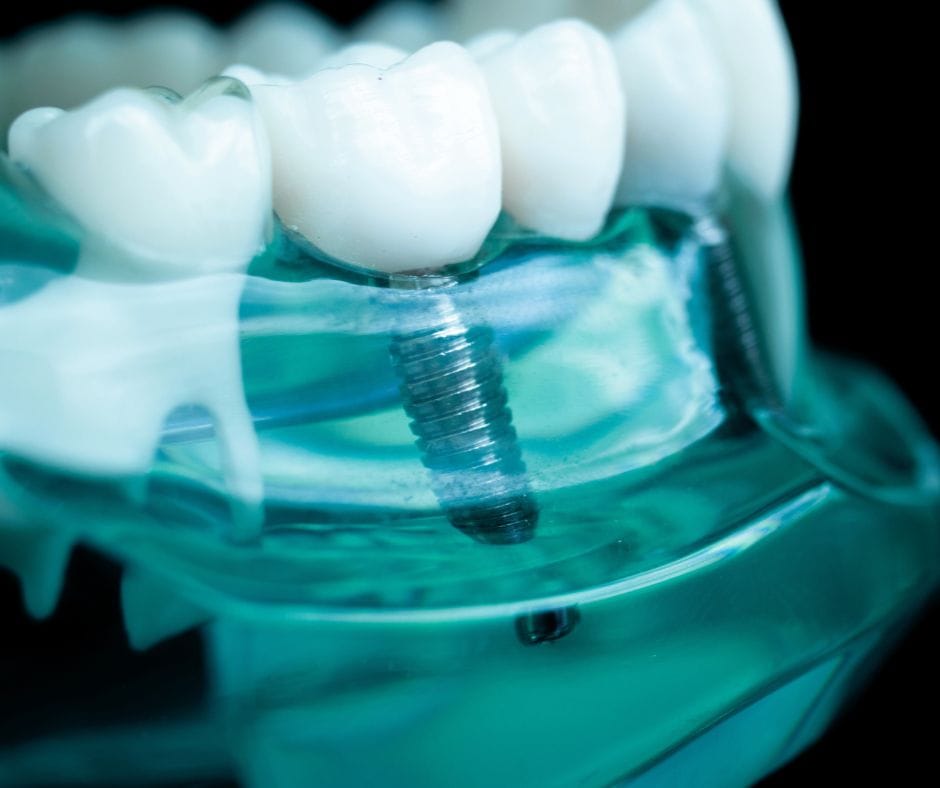 implantologia dentale