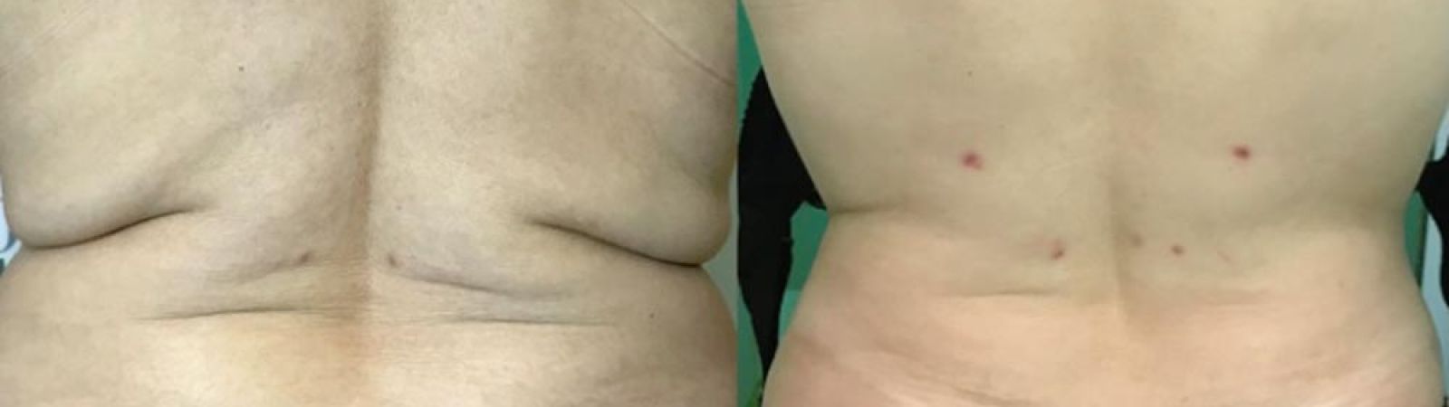 liposcultura Bergamo Liposcultura regione sottocostale con lassità marcata
