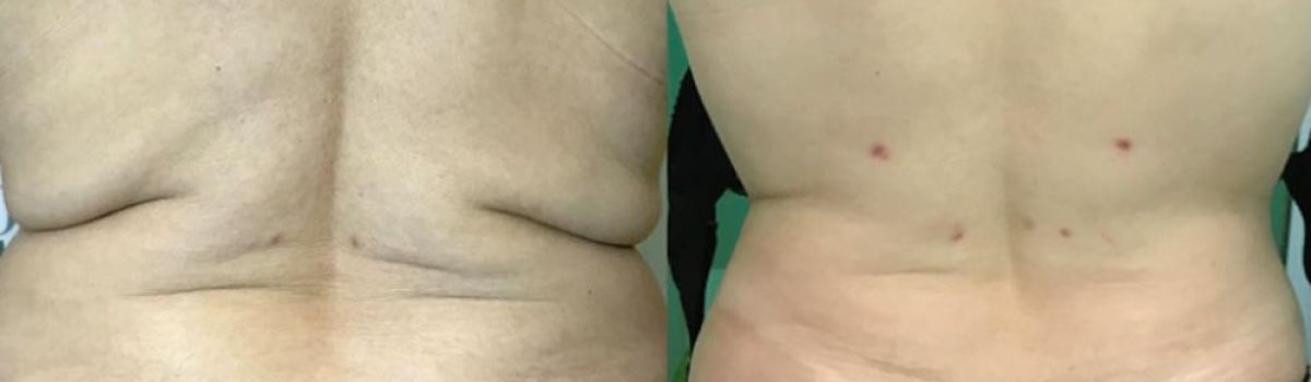 Liposcultura regione sottocostale con lassità marcata