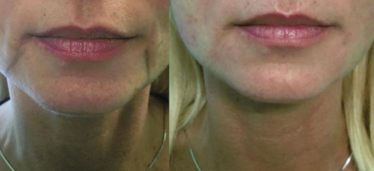 endolight lifting ENDOLIFTING Prima e Dopo