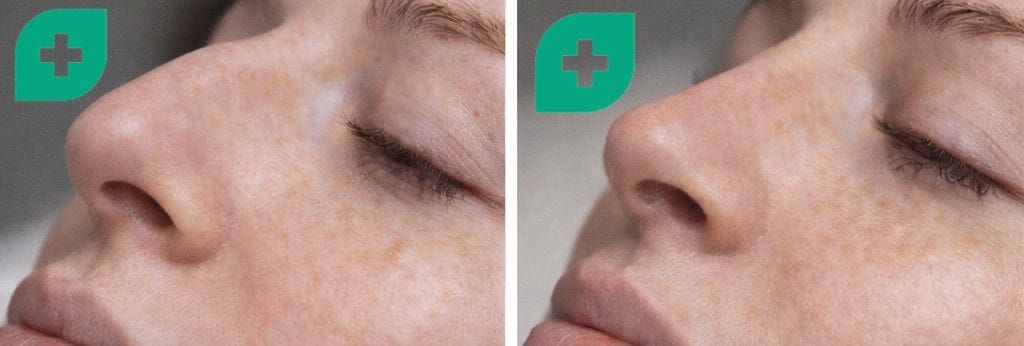 Rinoplastica non chirurgica Bergamo