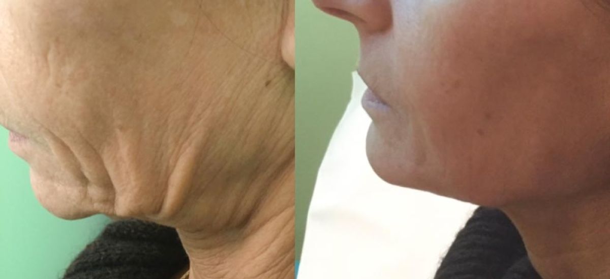 endolight lifting ENDOLIFTING + FILI DI TRAZIONE Prima e Dopo