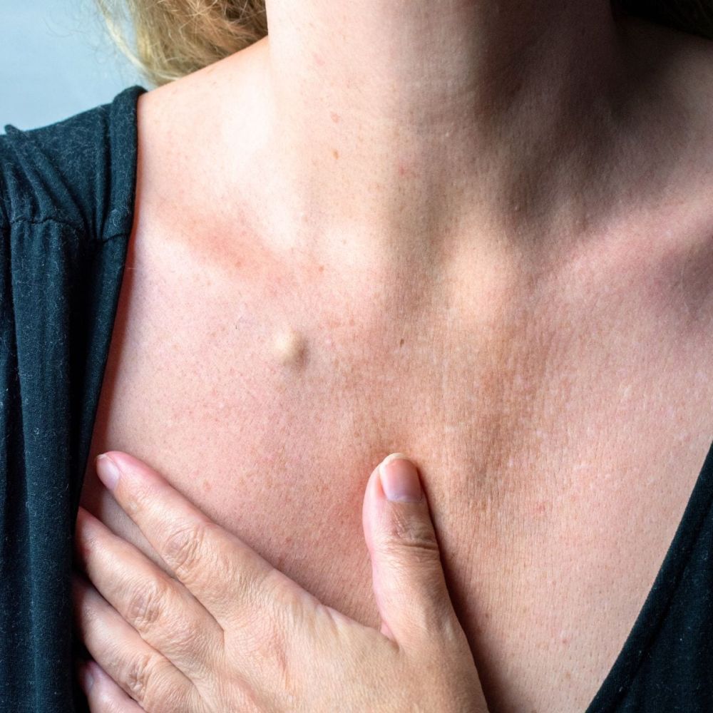 Rimozione di Cisti Sebacee