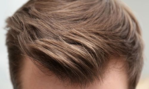 Trapianto di capelli – FUT e FUE Bergamo