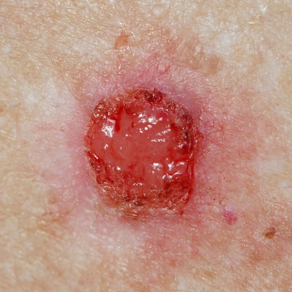 Rimozione di Spinalioma