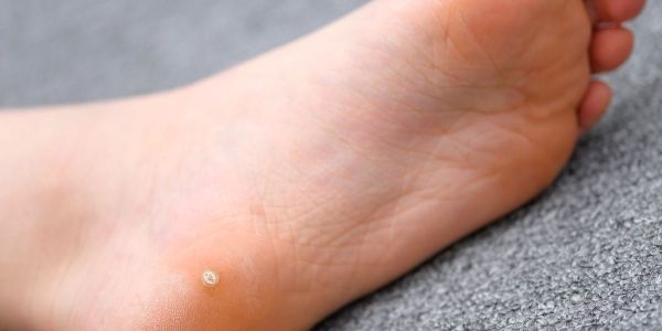 Rimozione di Verruche Test sierologici del Poliambulatorio Finazzi