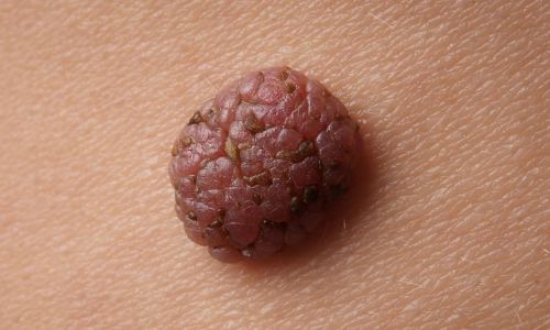 piccola chirurgia estetica Rimozione dei nei Bergamo