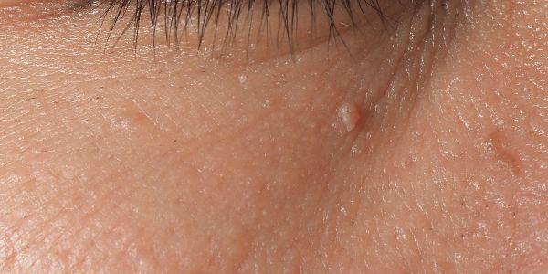 Rimozione di Verruche Test sierologici del Poliambulatorio Finazzi