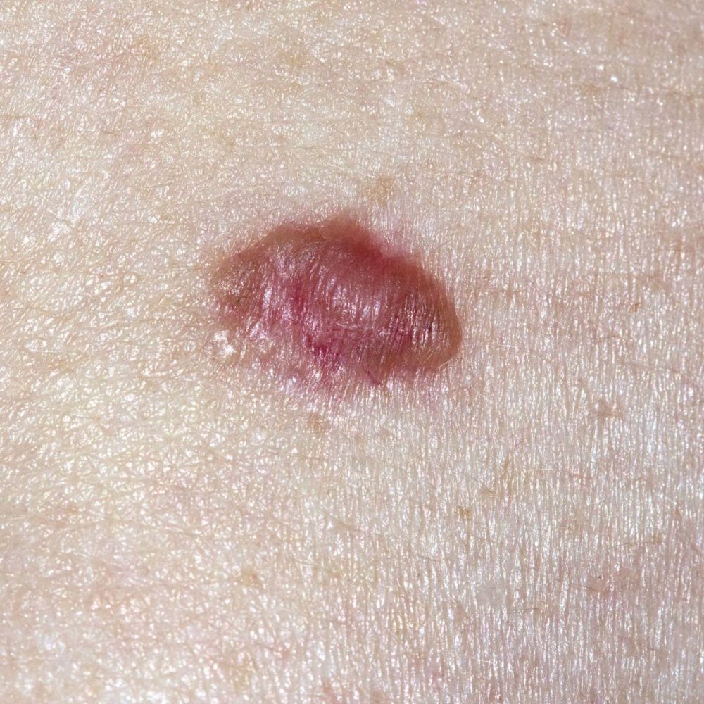 Rimozione di Basalioma