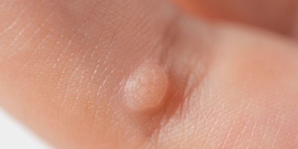 Rimozione di Verruche Test sierologici del Poliambulatorio Finazzi